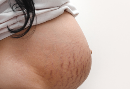 Stretch Mark Creams Featured Image