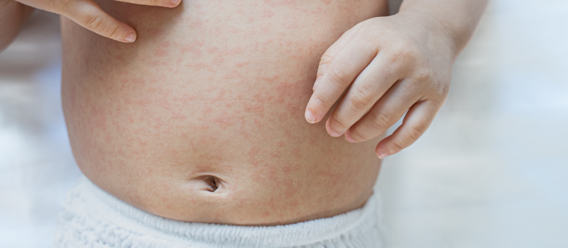 Unexpected Symptom Could Indicate Flu Featured Image